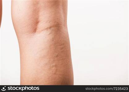 Closeup young Asian woman painful varicose and spider veins on leg, studio shot isolated on white background, Healthcare medical and hygiene skin body varicose veins problems care concept