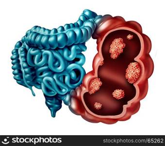 Colon cancer concept as a human intestine disease with forced perspective with microscopic malignant tumor inside the human anatomy as a 3D illustration.