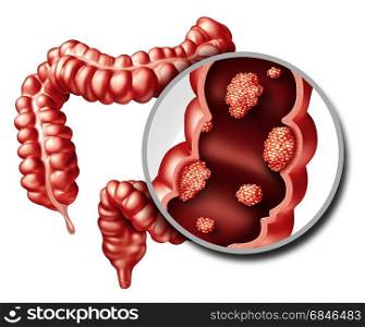 Colon or colorectal cancer concept as a medical illustration of a large intestine with a malignant tumor growth disease of the digestive system as a 3D illustration.