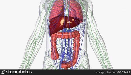 Colorectal cancer  CRC  is a common colon or rectal cancer that affects many patients over middle age. 3D rendering. Colorectal cancer  CRC  is a common colon or rectal cancer that affects many patients over middle age.