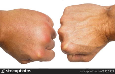 Comparing swollen male caucasian hands isolated towards white background