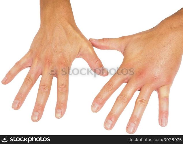 Comparing swollen male hands isolated towards white background