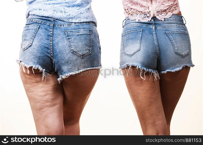 Comparison of female legs thighs with and without cellulite. Skin problem, body care, overweight and dieting concept.. Comparison of legs with and without cellulite