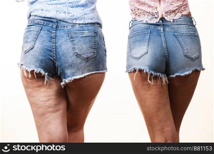 Comparison of female legs thighs with and without cellulite. Skin problem, body care, overweight and dieting concept.. Comparison of legs with and without cellulite