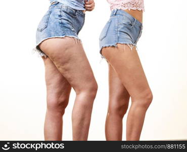 Comparison of female legs thighs with and without cellulite. Skin problem, body care, overweight and dieting concept.. Comparison of legs with and without cellulite