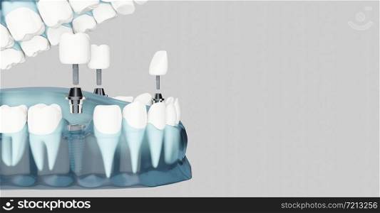 Component of Dental implants and copy space. Blue color transparent. 3d illustrations
