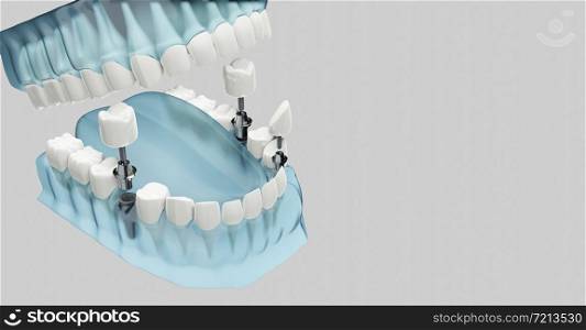 Component of Dental implants. Blue color transparent. 3d illustrations