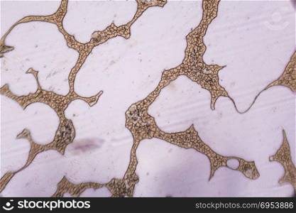 Congealed blood cells under the microscope.