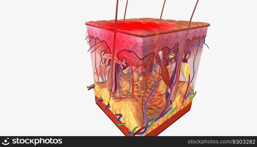 Contact Dermatitis in Skin Tissue 3D rendering. Contact Dermatitis in Skin Tissue