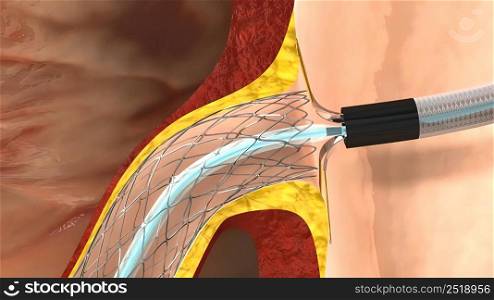 coronary angiography procedures 3D illustration. coronary angiography procedures 3d