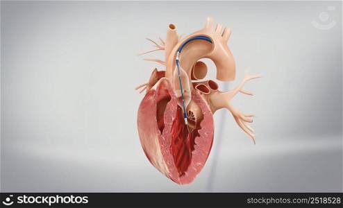 Coronary angioplasty is a procedure used to widen blocked or narrowed coronary arteries the main blood vessels supplying the heart. 3D illustration. Coronary angioplasty and stent insertion