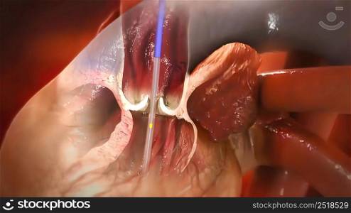 Coronary angioplasty is a procedure used to widen blocked or narrowed coronary arteries the main blood vessels supplying the heart. 3D illustration. Coronary angioplasty and stent insertion