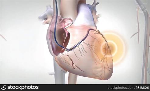 Coronary artery bypass grafting (CABG) is a type of surgery that improves blood flow to the heart. Its used for people who have severe coronary heart disease.3D illustration. A surgical procedure to reduce the risk of death, Coronary Artery Bypass Graft