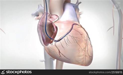 Coronary artery bypass grafting (CABG) is a type of surgery that improves blood flow to the heart. Its used for people who have severe coronary heart disease.3D illustration. A surgical procedure to reduce the risk of death, Coronary Artery Bypass Graft