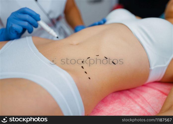 Cosmetician applies markers to female patient body, botox injections preparation. Rejuvenation procedure in beautician salon. Cosmetic surgery against wrinkles. Cosmetician applies markers to female patient body