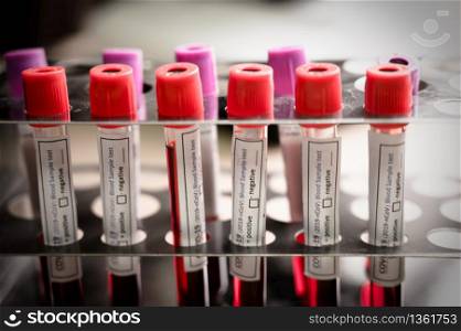 COVID-19 blood sample test, 2019-nCoV Coronavirus check-up in laboratory