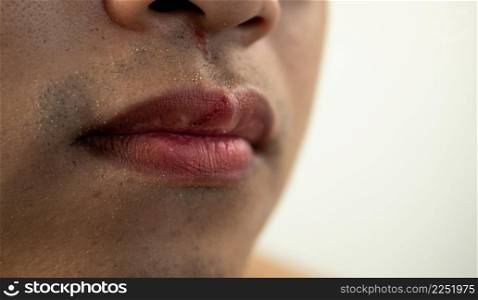 Cracked lips of man in winter season. Close up shot. This man skin is asian style.