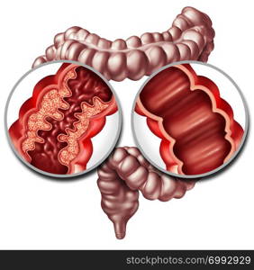 Crohn syndrome disease or crohns illness and healthy colon as a medical concept with a close up of a human intestine with inflammation symptoms causing obstruction as a 3D illustration.