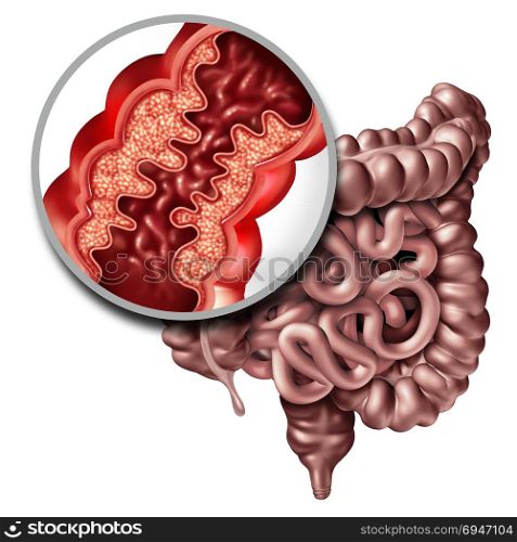 Crohna??s disease or crohn illness medical concept as a close up of a human intestine with inflammation symptoms causing obstruction as a 3D illustration.