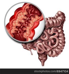 Crohna??s disease or crohn illness medical concept as a close up of a human intestine with inflammation symptoms causing obstruction as a 3D illustration.