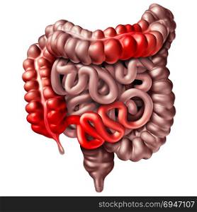 Crohna??s disease or crohn illness medical concept as human intestines with inflammation symptoms causing obstruction as a 3D illustration.