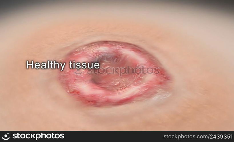 Crust and dressing following a burn or cauterization of the skin 3D illustration. Crust and dressing following a burn or cauterization of the skin