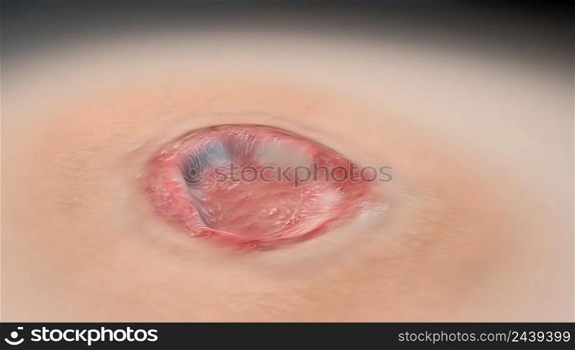 Crust and dressing following a burn or cauterization of the skin 3D illustration. Crust and dressing following a burn or cauterization of the skin