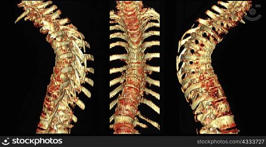 CT scan of thoracic spine with osteoporosis