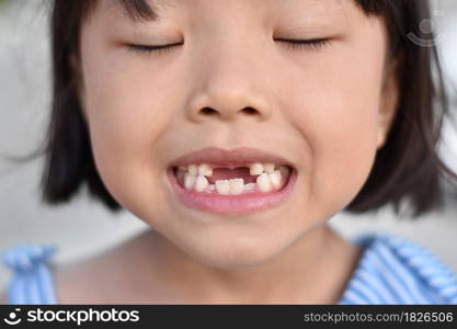 Cute little girl smile with her broken tooth. Close up of child front tooth broken.