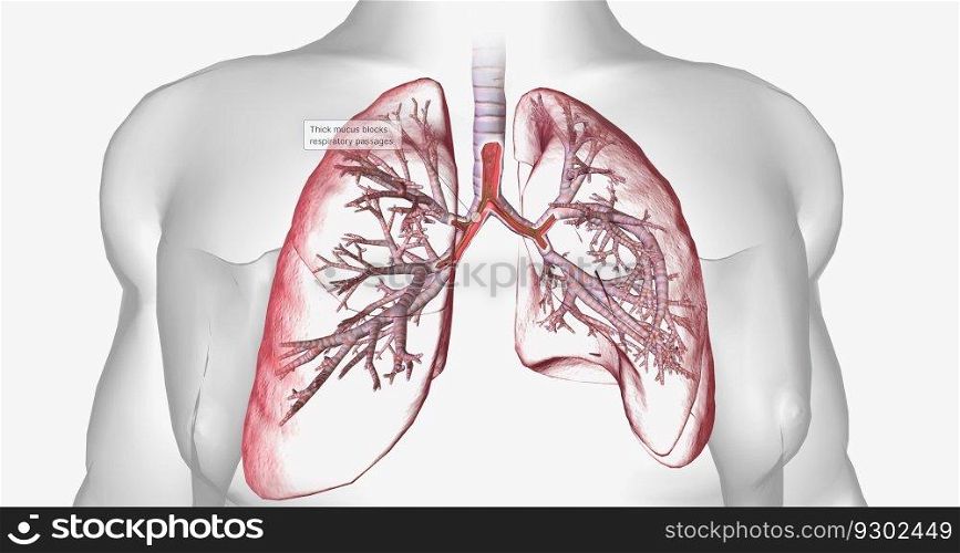 Cystic fibrosis is a genetically inherited disease that affects secretory cells throughout the body. 3D rendering. Cystic fibrosis is a genetically inherited disease that affects secretory cells throughout the body.