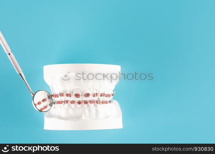 Dental braces model on blue background.