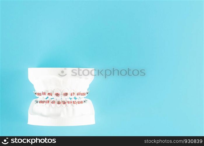 Dental braces model on blue background.