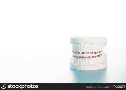 Dental braces model on white background.