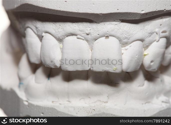 Dental casting gypsum model plaster cast stomatologic human jaws prothetic laboratory, technical shots