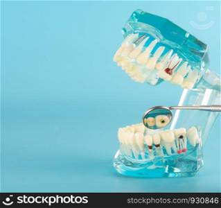 Dental implant model on blue background.