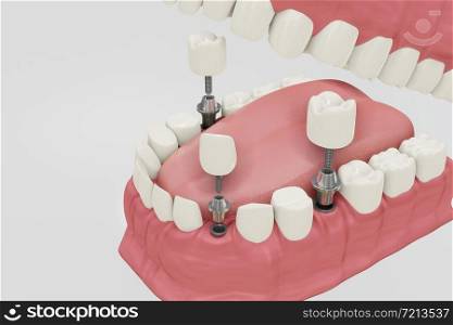 Dental Implants Treatment Procedure. Medically accurate 3D illustration dentures concept.