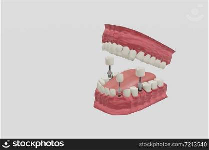 Dental Implants Treatment Procedure. Medically accurate 3D illustration dentures concept.
