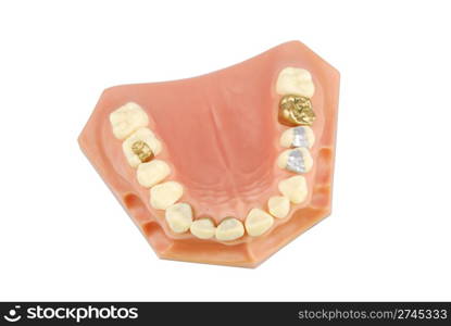 dental model showing different types of treatments (gold crown, porcelain veener, gold inlays, amalgam and composite fillings)