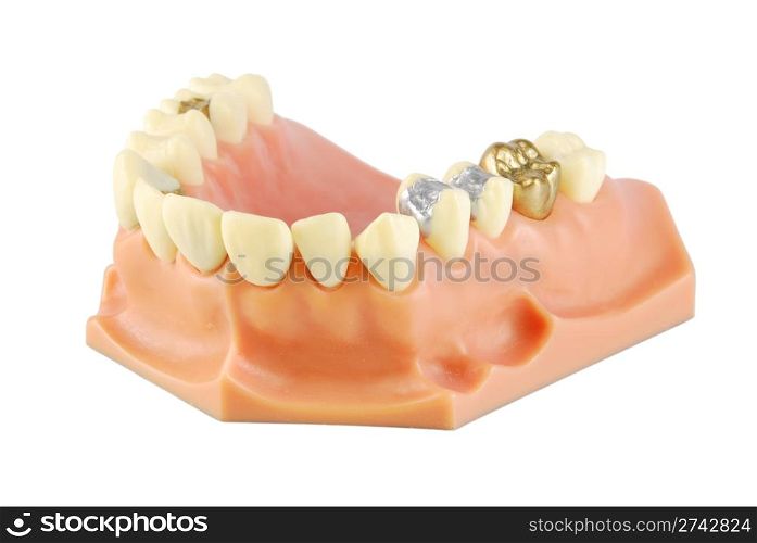 dental model showing different types of treatments on white (gold crown, porcelain veener, gold inlays, amalgam and composite fillings)
