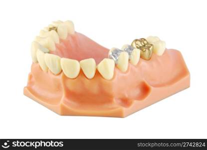dental model showing different types of treatments on white (gold crown, porcelain veener, gold inlays, amalgam and composite fillings)