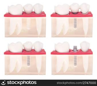 dental model with different types of treatments (implant placement, bonded bridge, crown over implant) isolated on white background