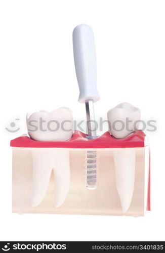 dental model with implant placement with screwdriver isolated on white background