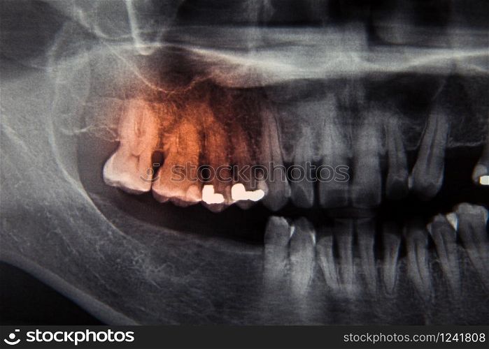 Dental x ray film for dental care concept