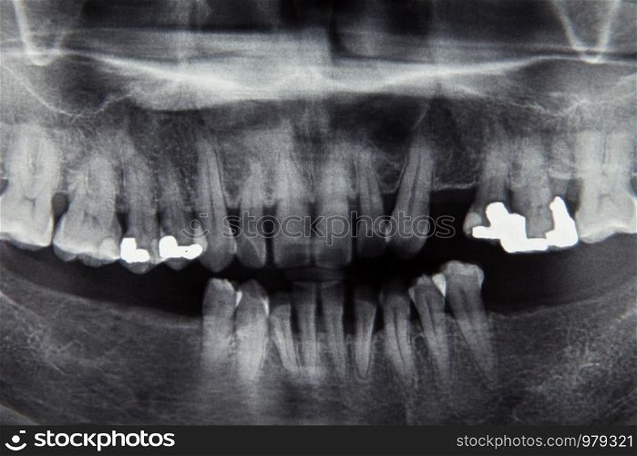 Dental x ray film for dental care concept