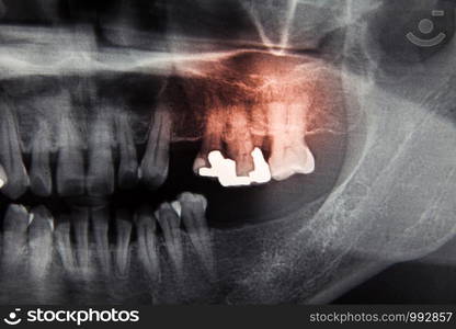 Dental x ray film for dental care concept