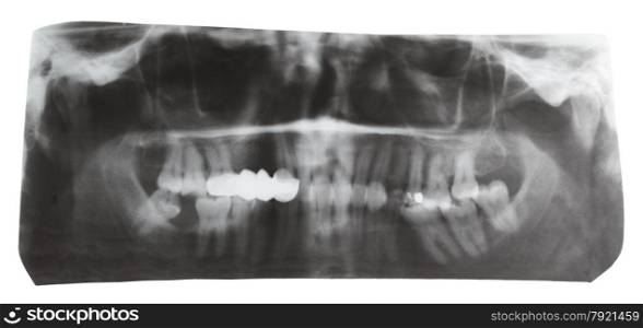 dental X-ray picture of human jaws isolated on white background