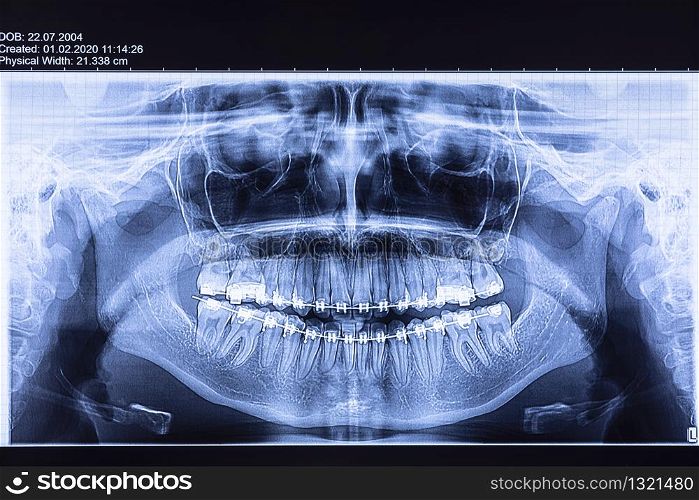Dental x-ray with braces. Radiography for teeth straightening and dental structures research concept.