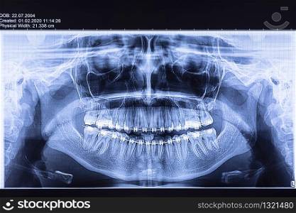Dental x-ray with braces. Radiography for teeth straightening and dental structures research concept.