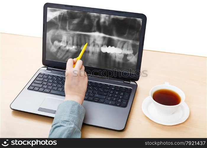 dentist analyzes X-ray picture of jaws on laptop screen