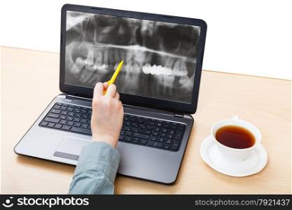 dentist analyzes X-ray picture of jaws on laptop screen